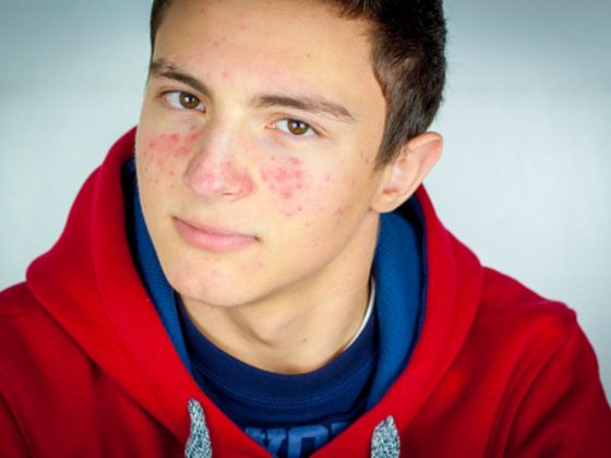 5 Components That Have an effect on Zits Breakouts in Teenagers
