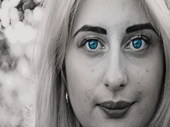 5 Ways to Get Rid of Hyperpigmentation