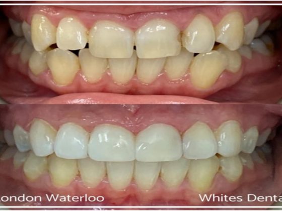 Do it’s a must to brush veneers?