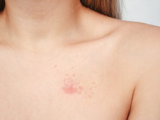 How To Stop Getting a Yeast An infection On The Pores and skin?