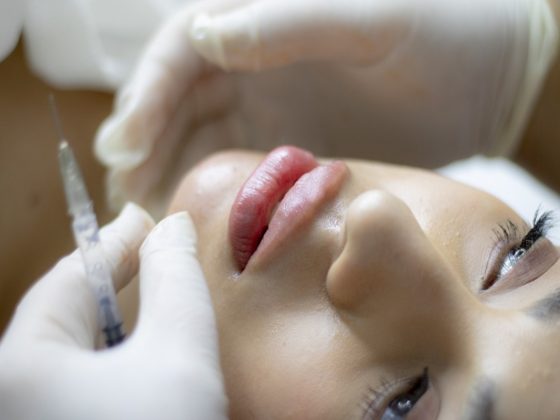 Lip Filler – What Is All The Fuss About?