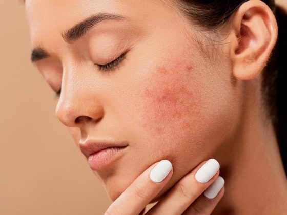 Acne: Facts, Myths and Tips
