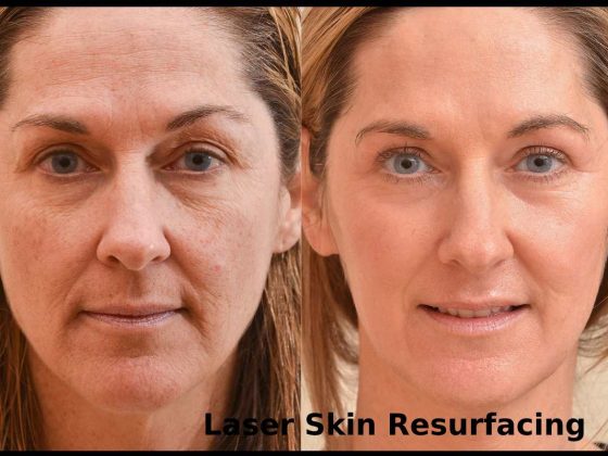 Laser Pores and skin Resurfacing: Issues You Want To Know