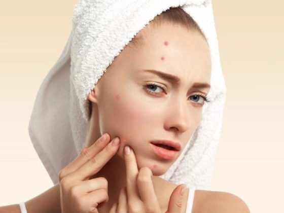 5 Natural Ways To Treat Hard Pimple? 